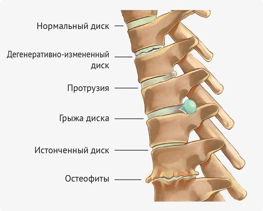 Deformità del disco per l'osteocondosi lombare