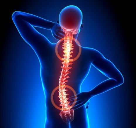 Osteocondrosi della colonna vertebrale