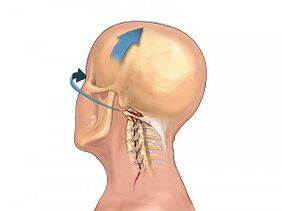 Come si manifesta l'osteocondosi della colonna cervicale