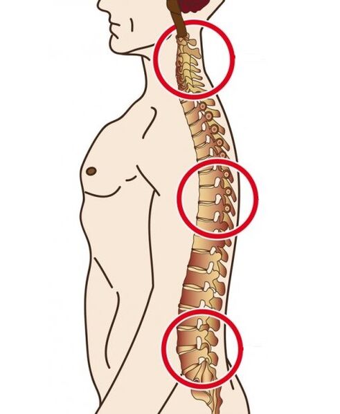 Dipartimenti spinali in cui si verifica l'osteocondosi