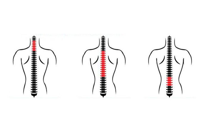 Come si manifesta l'osteocondrosi