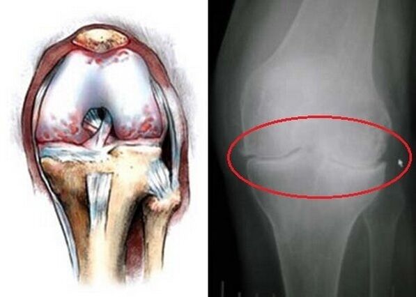 artrosi dell'articolazione del ginocchio