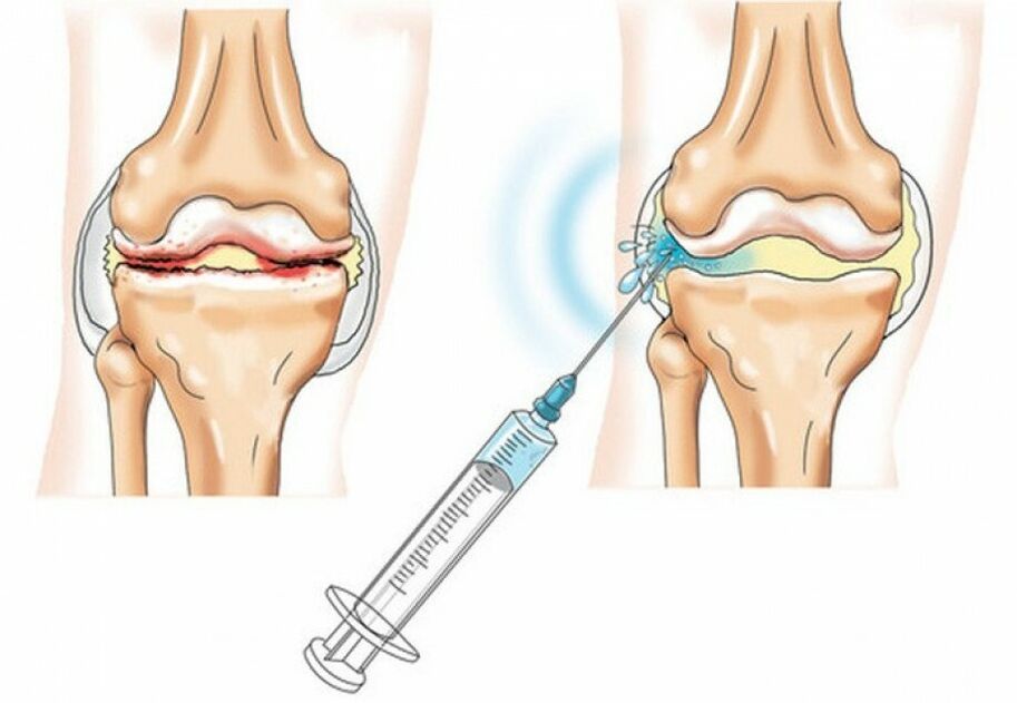 iniezione nell'articolazione del ginocchio con artrosi
