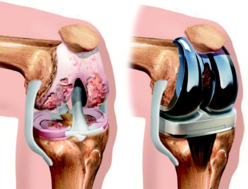 In caso di danno totale all'articolazione del ginocchio causato dall'artrosi, è possibile ripristinarlo mediante endoprotesi