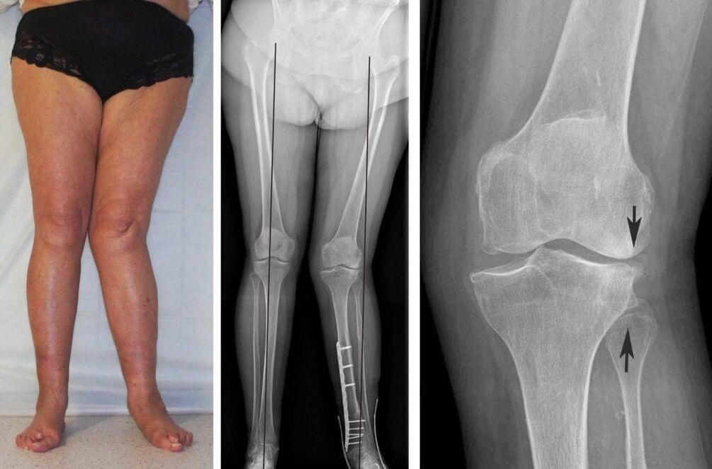 L'artrosi avanzata delle articolazioni del ginocchio è chiaramente visibile visivamente anche senza radiografie