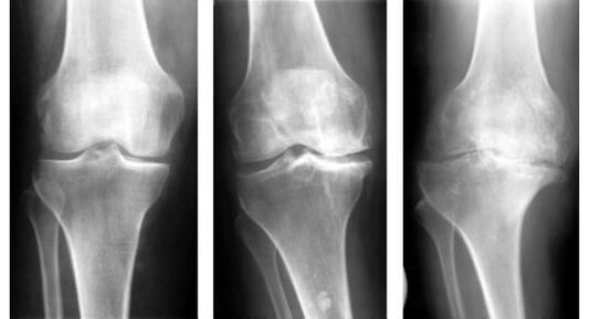 Una misura diagnostica obbligatoria quando si identifica l'artrosi del ginocchio è una radiografia